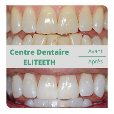 BLANCHIMENT DENT STRASBOURG CENTRE DENTAIRE SCHILTIGHEIM 